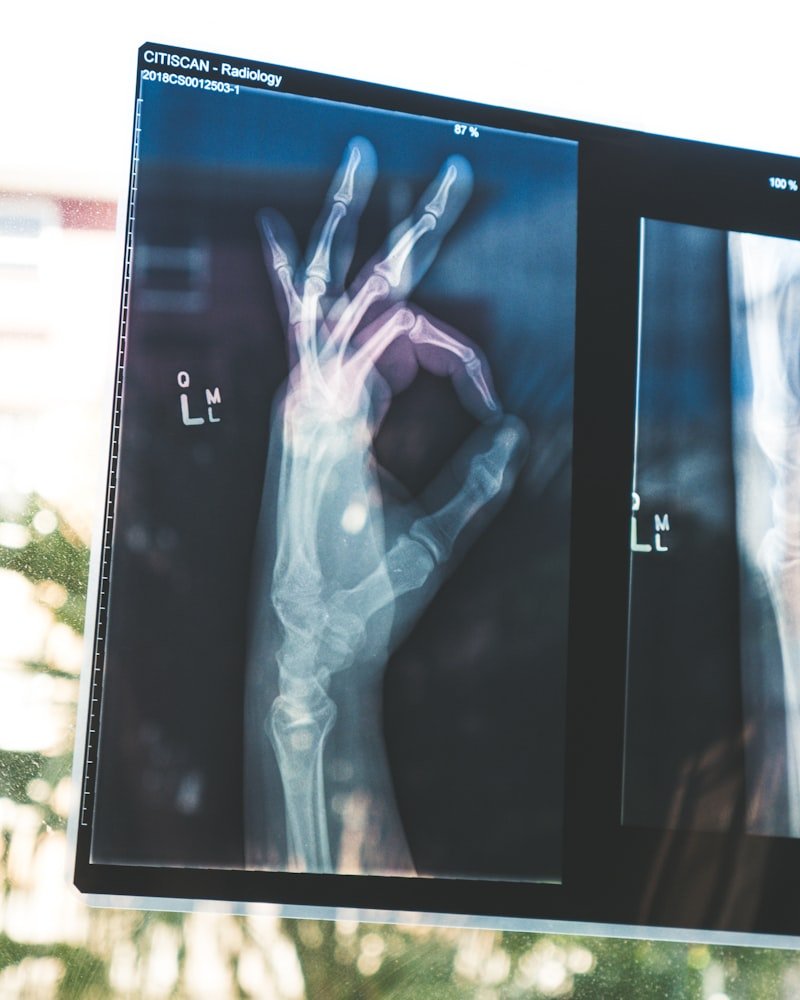 Fracture Rehabilitation
